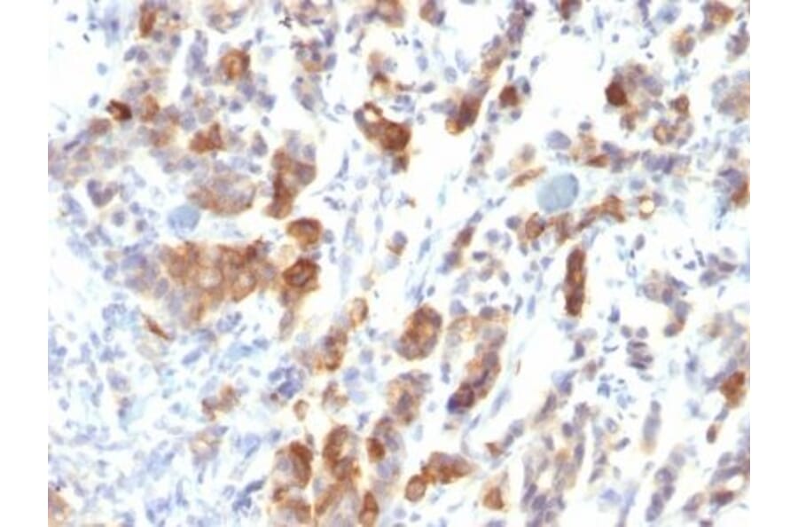 Immunohistochemistry (formalin-fixed, paraffin-embedded) - Anti-MUC5AC Antibody [MUC5AC/917] (CF®640R) (A352955) - Antibodies.com
