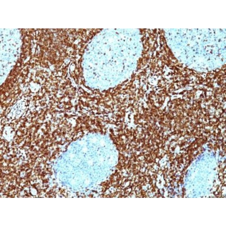 Immunohistochemistry (formalin-fixed, paraffin-embedded) - Anti-Bcl-2 Antibody [BCL2/782 + BCL2/796] (CF®488A) (A353048) - Antibodies.com