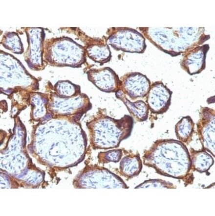 Immunohistochemistry (formalin-fixed, paraffin-embedded) - Anti-EGFR Antibody [31G7] (CF®740) (A353178) - Antibodies.com