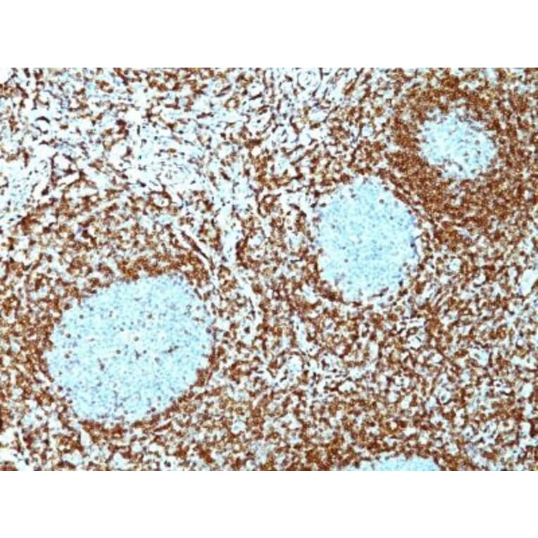Immunohistochemistry (formalin-fixed, paraffin-embedded) - Anti-Bcl-2 Antibody [100/D5 + 124] (CF®647) (A353216) - Antibodies.com