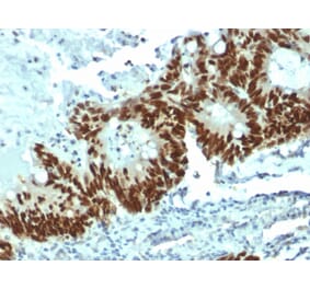 Immunohistochemistry (formalin-fixed, paraffin-embedded) - Anti-p53 Antibody [DO-1] (CF®640R) (A353457) - Antibodies.com