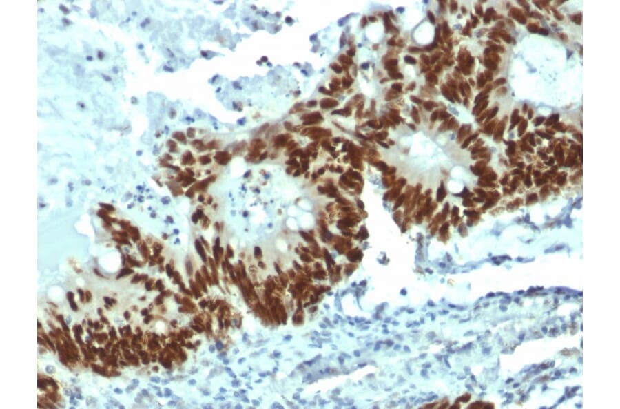 Immunohistochemistry (formalin-fixed, paraffin-embedded) - Anti-p53 Antibody [DO-1] (CF®640R) (A353457) - Antibodies.com