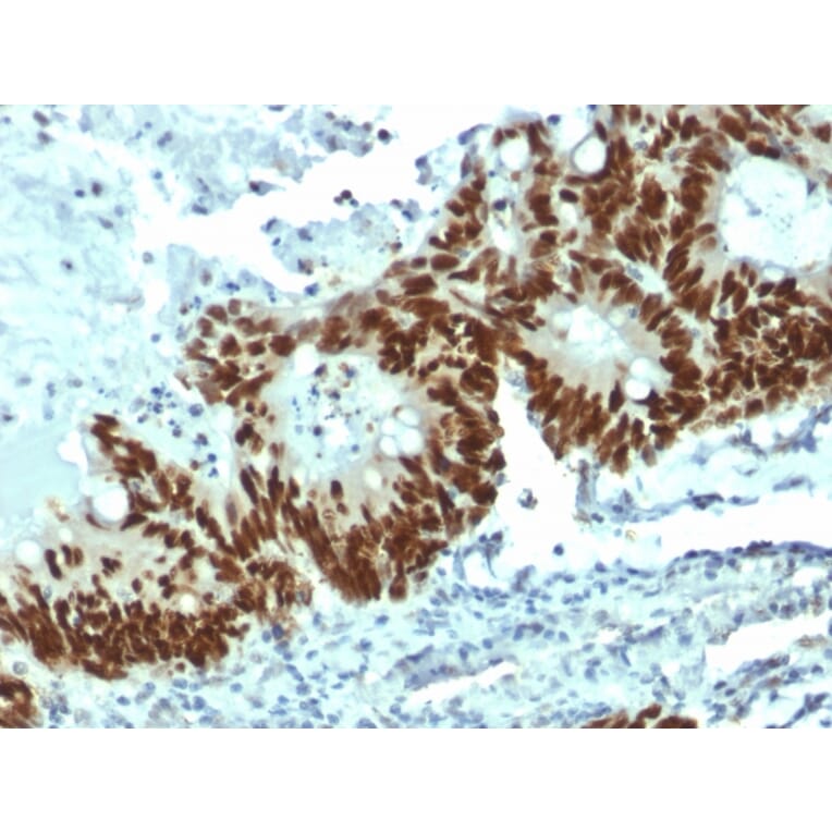 Immunohistochemistry (formalin-fixed, paraffin-embedded) - Anti-p53 Antibody [DO-1] (CF®740) (A353460) - Antibodies.com