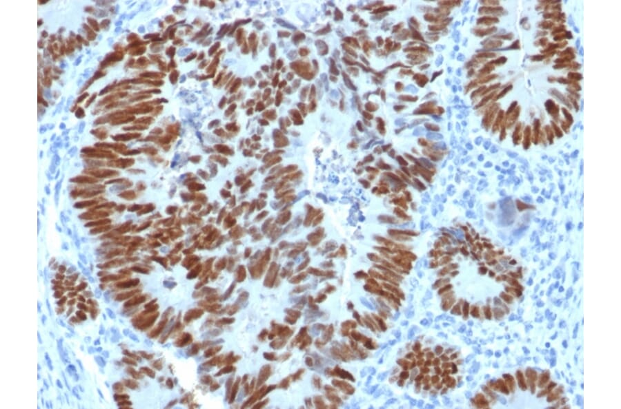 Immunohistochemistry (formalin-fixed, paraffin-embedded) - Anti-p53 Antibody [N/A] (CF®640R) (A353609) - Antibodies.com