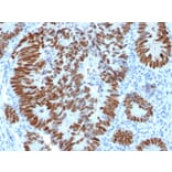 Immunohistochemistry (formalin-fixed, paraffin-embedded) - Anti-p53 Antibody [N/A] (CF®568) (A353611) - Antibodies.com