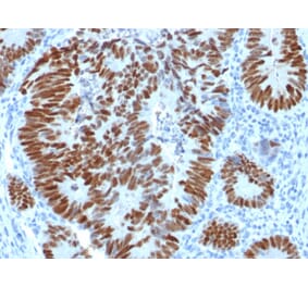 Immunohistochemistry (formalin-fixed, paraffin-embedded) - Anti-p53 Antibody [N/A] (CF®740) (A353612) - Antibodies.com