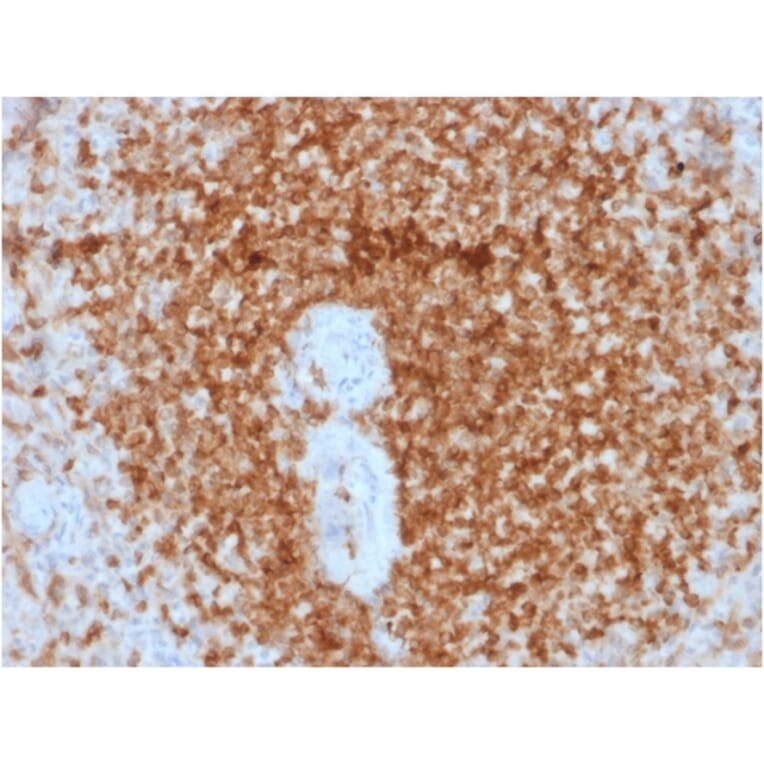 Immunohistochemistry (formalin-fixed, paraffin-embedded) - Anti-Bcl-2 Antibody [rBCL2/796] (CF®740) (A353636) - Antibodies.com