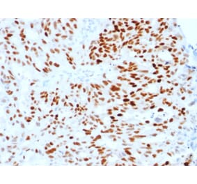 Immunohistochemistry (formalin-fixed, paraffin-embedded) - Anti-Estrogen Receptor alpha Antibody [ESR1/1904] (CF®647) (A353642) - Antibodies.com