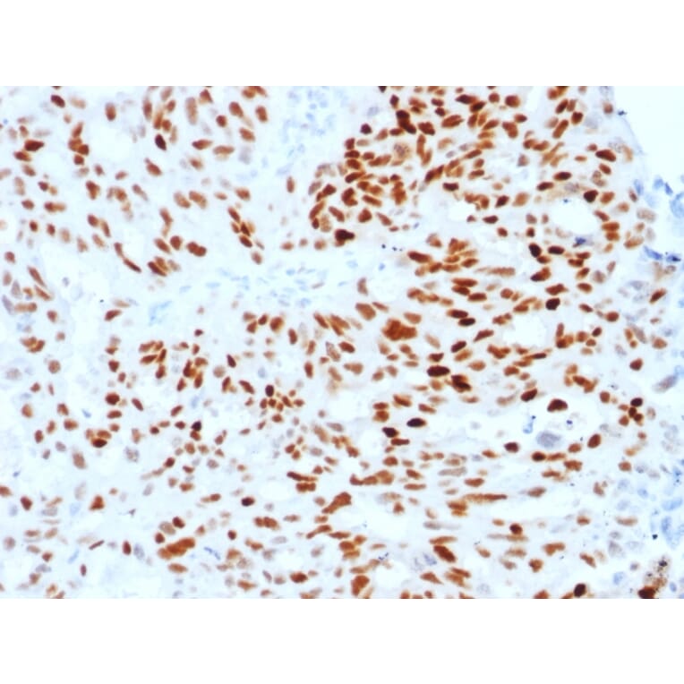 Immunohistochemistry (formalin-fixed, paraffin-embedded) - Anti-Estrogen Receptor alpha Antibody [ESR1/1904] (CF®488A) (A353645) - Antibodies.com