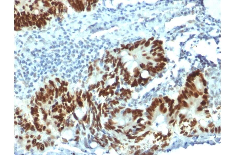 Immunohistochemistry (formalin-fixed, paraffin-embedded) - Anti-p53 Antibody [PAb1801] (CF®647) (A353650) - Antibodies.com