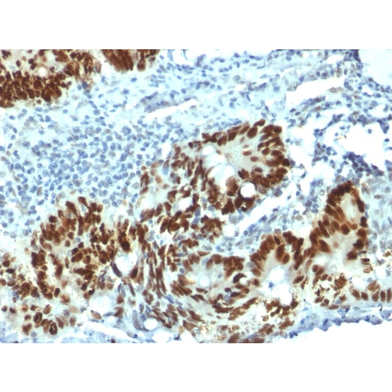 Immunohistochemistry (formalin-fixed, paraffin-embedded) - Anti-p53 Antibody [PAb1801] (CF®647) (A353650) - Antibodies.com