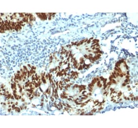 Immunohistochemistry (formalin-fixed, paraffin-embedded) - Anti-p53 Antibody [PAb1801] (CF®568) (A353651) - Antibodies.com