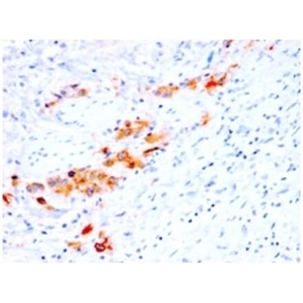 Immunohistochemistry (formalin-fixed, paraffin-embedded) - Anti-CD44v4 Antibody [rCD44v4/1219] (CF®405S) (A353672) - Antibodies.com