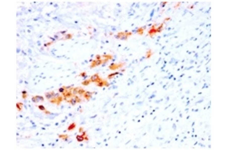 Immunohistochemistry (formalin-fixed, paraffin-embedded) - Anti-CD44v4 Antibody [rCD44v4/1219] (CF®740) (A353676) - Antibodies.com