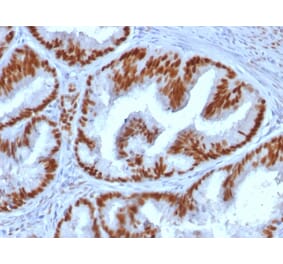 Immunohistochemistry (formalin-fixed, paraffin-embedded) - Anti-Estrogen Receptor alpha Antibody [ESR1/1935] (CF®740) (A353684) - Antibodies.com