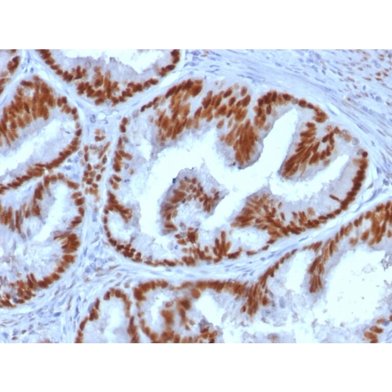 Immunohistochemistry (formalin-fixed, paraffin-embedded) - Anti-Estrogen Receptor alpha Antibody [ESR1/1935] (CF®740) (A353684) - Antibodies.com