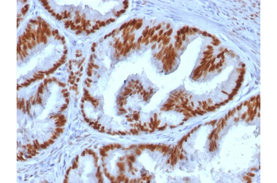 Immunohistochemistry (formalin-fixed, paraffin-embedded) - Anti-Estrogen Receptor alpha Antibody [ESR1/1935] (CF®488A) (A353685) - Antibodies.com