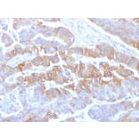 Immunohistochemistry (formalin-fixed, paraffin-embedded) - Anti-E-Cadherin Antibody [rCDH1/1525] (CF®640R) (A353782) - Antibodies.com
