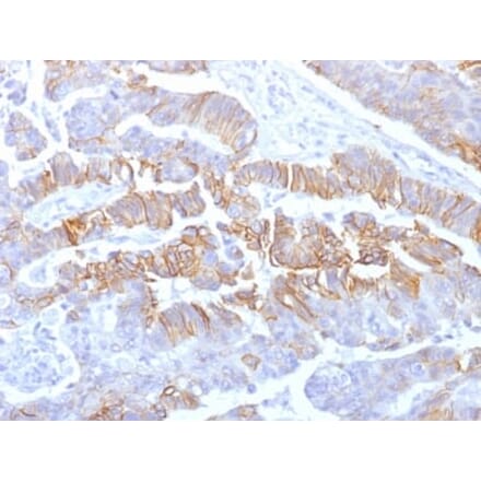 Immunohistochemistry (formalin-fixed, paraffin-embedded) - Anti-E-Cadherin Antibody [rCDH1/1525] (CF®647) (A353783) - Antibodies.com