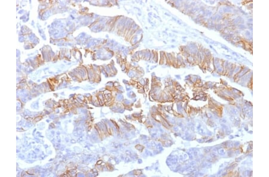 Immunohistochemistry (formalin-fixed, paraffin-embedded) - Anti-E-Cadherin Antibody [rCDH1/1525] (CF®740) (A353785) - Antibodies.com