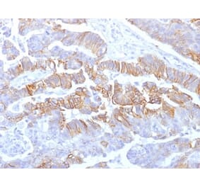 Immunohistochemistry (formalin-fixed, paraffin-embedded) - Anti-E-Cadherin Antibody [rCDH1/1525] (CF®594) (A353787) - Antibodies.com