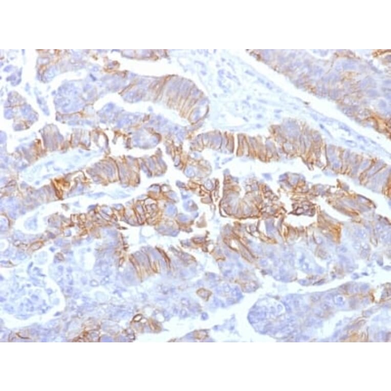 Immunohistochemistry (formalin-fixed, paraffin-embedded) - Anti-E-Cadherin Antibody [rCDH1/1525] (CF®594) (A353787) - Antibodies.com