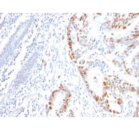 Immunohistochemistry (formalin-fixed, paraffin-embedded) - Anti-p53 Antibody [rBP53-12] (CF®405S) (A353805) - Antibodies.com