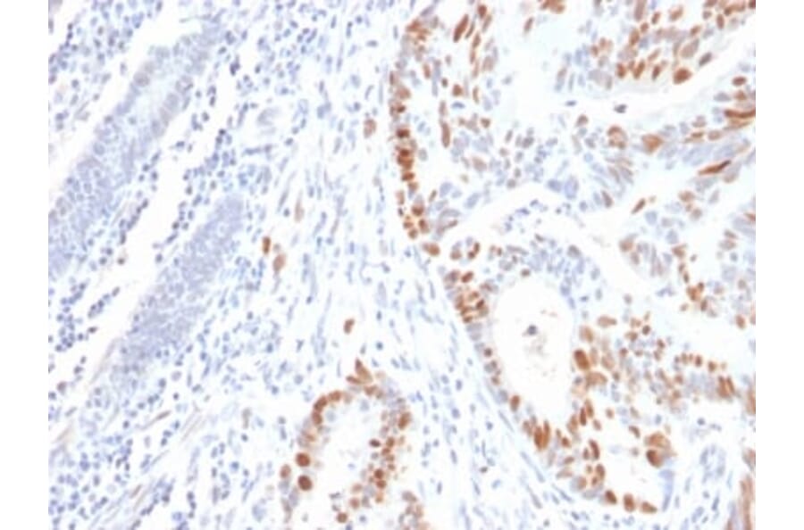 Immunohistochemistry (formalin-fixed, paraffin-embedded) - Anti-p53 Antibody [rBP53-12] (CF®647) (A353807) - Antibodies.com
