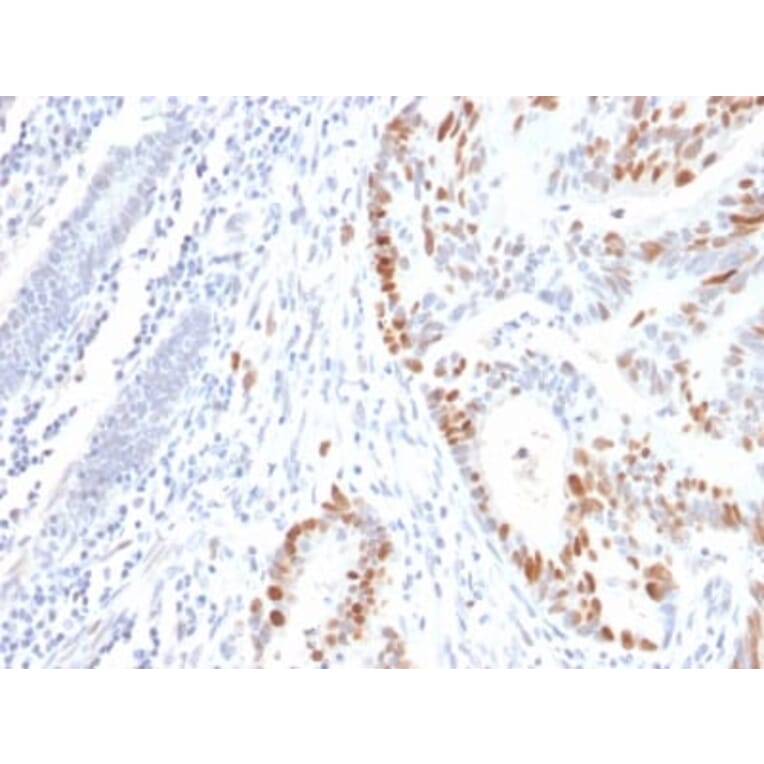 Immunohistochemistry (formalin-fixed, paraffin-embedded) - Anti-p53 Antibody [rBP53-12] (Biotin) (A353812) - Antibodies.com