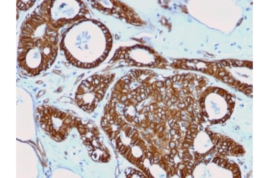 Immunohistochemistry (formalin-fixed, paraffin-embedded) - Anti-beta Catenin Antibody [rCTNNB1/2173] (CF®647) (A353831) - Antibodies.com