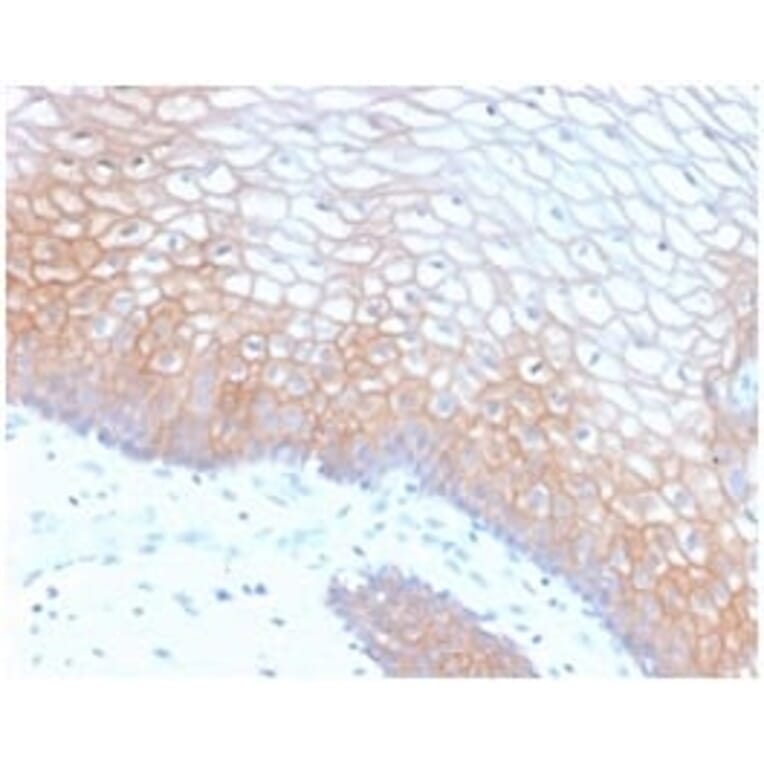 Immunohistochemistry (formalin-fixed, paraffin-embedded) - Anti-E-Cadherin Antibody [CDH1/2208R] (CF®640R) (A353846) - Antibodies.com