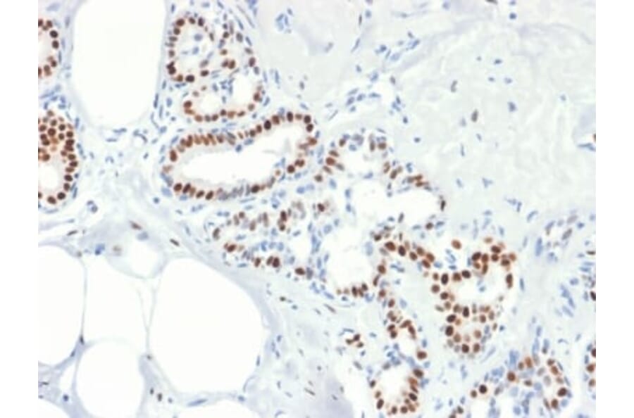 Immunohistochemistry (formalin-fixed, paraffin-embedded) - Anti-Estrogen Receptor alpha Antibody [rESR1/1935] (CF®640R) (A353878) - Antibodies.com