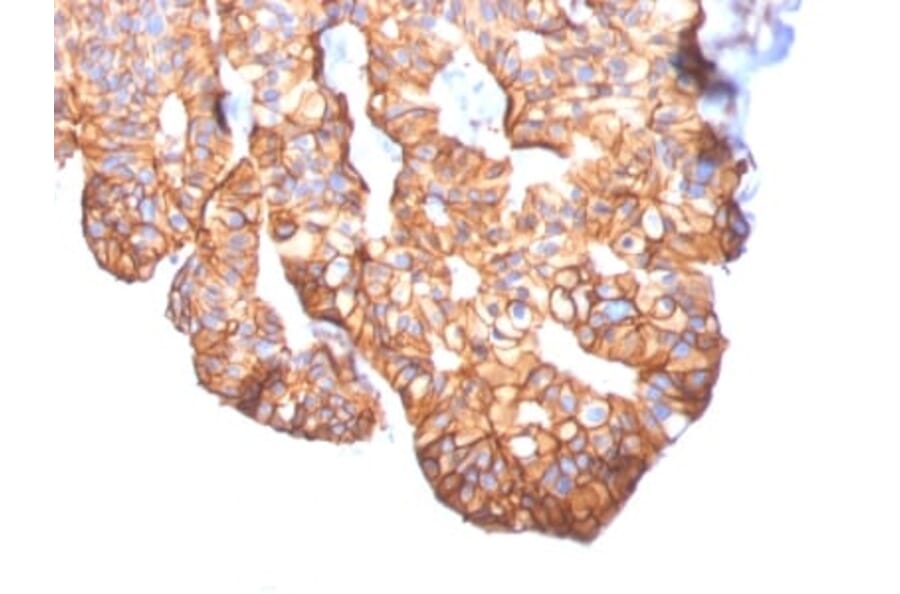 Immunohistochemistry (formalin-fixed, paraffin-embedded) - Anti-ErbB2 Antibody [ERBB2/2452] (CF®640R) (A353966) - Antibodies.com