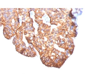 Immunohistochemistry (formalin-fixed, paraffin-embedded) - Anti-ErbB2 Antibody [ERBB2/2452] (CF®568) (A353968) - Antibodies.com