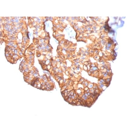 Immunohistochemistry (formalin-fixed, paraffin-embedded) - Anti-ErbB2 Antibody [ERBB2/2452] (CF®568) (A353968) - Antibodies.com