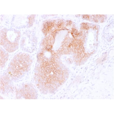 Immunohistochemistry (formalin-fixed, paraffin-embedded) - Anti-CD44v6 Antibody [CD44V6/2496] (CF®640R) (A354014) - Antibodies.com
