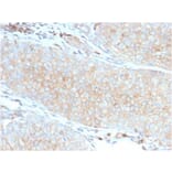 Immunohistochemistry (formalin-fixed, paraffin-embedded) - Anti-PD-L1 Antibody [PDL1/2746] (CF®640R) (A354103) - Antibodies.com
