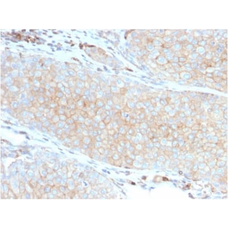 Immunohistochemistry (formalin-fixed, paraffin-embedded) - Anti-PD-L1 Antibody [PDL1/2746] (CF®647) (A354105) - Antibodies.com