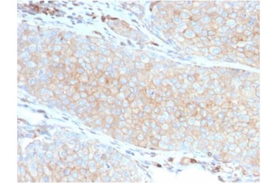 Immunohistochemistry (formalin-fixed, paraffin-embedded) - Anti-PD-L1 Antibody [PDL1/2746] (CF®568) (A354106) - Antibodies.com