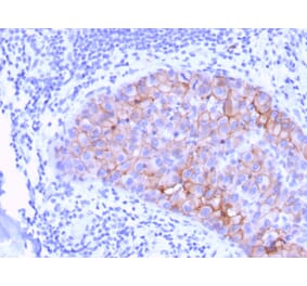 Immunohistochemistry (formalin-fixed, paraffin-embedded) - Anti-ErbB2 Antibody [ERBB2/3078] (CF®405S) (A354199) - Antibodies.com