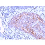 Immunohistochemistry (formalin-fixed, paraffin-embedded) - Anti-ErbB2 Antibody [ERBB2/3078] (CF®405S) (A354199) - Antibodies.com