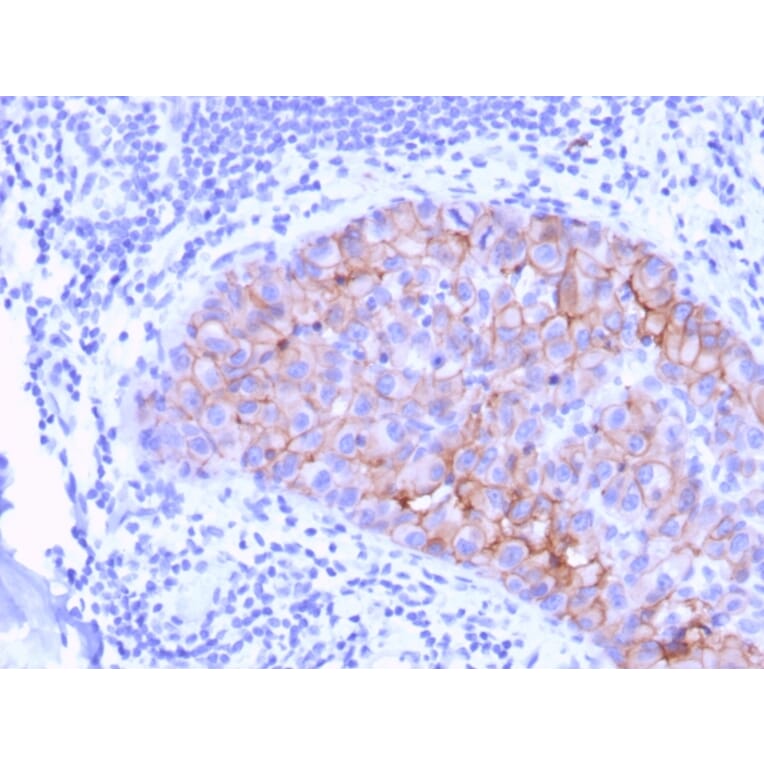 Immunohistochemistry (formalin-fixed, paraffin-embedded) - Anti-ErbB2 Antibody [ERBB2/3078] (CF®640R) (A354200) - Antibodies.com