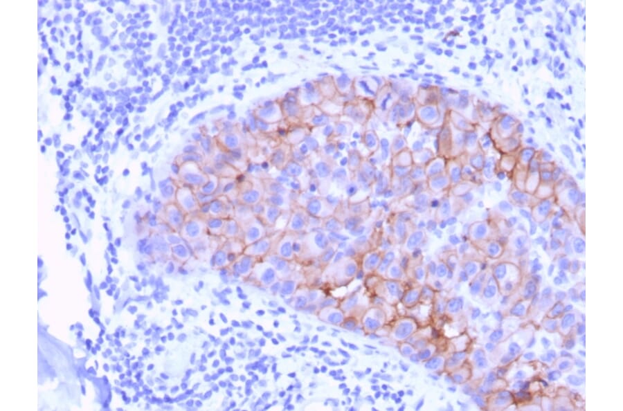 Immunohistochemistry (formalin-fixed, paraffin-embedded) - Anti-ErbB2 Antibody [ERBB2/3078] (CF®740) (A354203) - Antibodies.com
