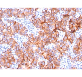 Immunohistochemistry (formalin-fixed, paraffin-embedded) - Anti-ErbB2 Antibody [ERBB2/3079] (CF®640R) (A354208) - Antibodies.com