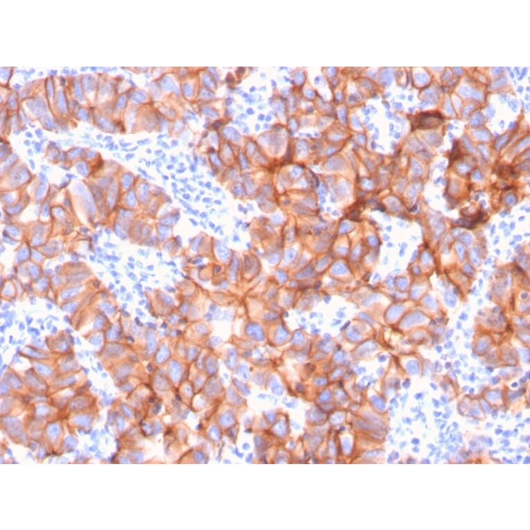 Immunohistochemistry (formalin-fixed, paraffin-embedded) - Anti-ErbB2 Antibody [ERBB2/3079] (CF®568) (A354210) - Antibodies.com