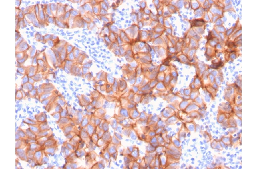 Immunohistochemistry (formalin-fixed, paraffin-embedded) - Anti-ErbB2 Antibody [ERBB2/3079] (CF®740) (A354211) - Antibodies.com