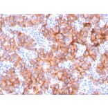Immunohistochemistry (formalin-fixed, paraffin-embedded) - Anti-ErbB2 Antibody [ERBB2/3079] (CF®740) (A354211) - Antibodies.com