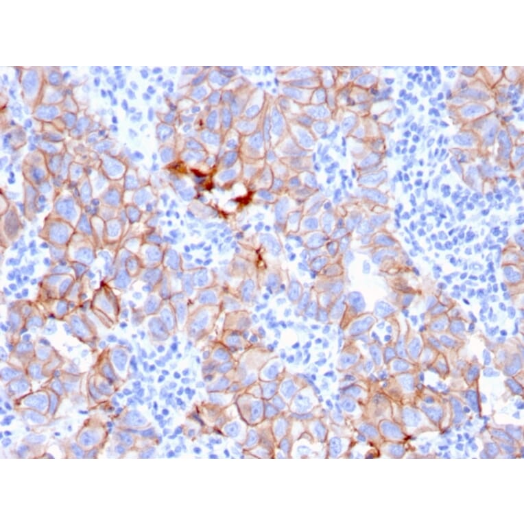 Immunohistochemistry (formalin-fixed, paraffin-embedded) - Anti-ErbB2 Antibody [ERBB2/3080] (CF®405S) (A354215) - Antibodies.com