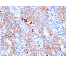 Immunohistochemistry (formalin-fixed, paraffin-embedded) - Anti-ErbB2 Antibody [ERBB2/3080] (CF®488A) (A354220) - Antibodies.com