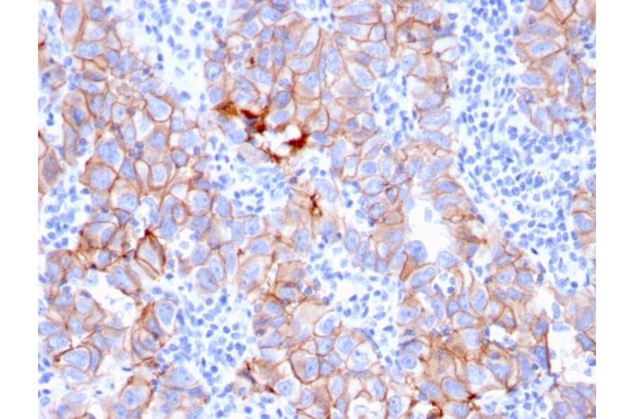 Immunohistochemistry (formalin-fixed, paraffin-embedded) - Anti-ErbB2 Antibody [ERBB2/3080] (CF®488A) (A354220) - Antibodies.com